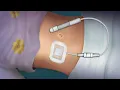 Peritoneal Dialysis Catheter