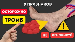 Неожиданные ПРИЗНАКИ ТРОМБА! Тело ПРЕДУПРЕЖДАЕТ ЗА 24 ЧАСА!