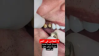 استبدال تلبيسات معدنية قديمة وتركيب اسنان زيركون دندنها