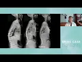 Breaking the PJK Cycle Outcomes of Post Surgical Bracing in Deformity Correction