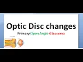 Ophthalmology 236 b Optic Disc Changes Early Advanced Atrophy signs Primary Open Angle Glaucoma POAG