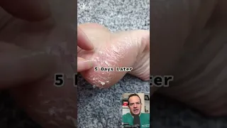 DOCTOR REACTS TO CHEMICAL FOOT PEEL Shorts Reaction 