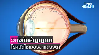  ดวงตาสามารถช่วยตรวจหาโรคอัลไซเมอร์ได้อย่างไร 