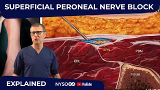 Download Superficial Peroneal Nerve Block - Crash course with Dr. Hadzic MP3