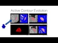 RSNA 2016 ITK-SNAP Training - Semi-Automatic Segmentation no