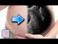 How to predict if you will have an early miscarriage with ultrasound