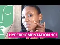 Download Lagu What is Hyperpigmentation? and How to Treat? | Hyperpigmentation 101