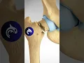 Download Lagu See what happens in a Femoral Neck Fracture and ORIF