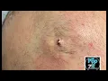 Large inflamed cyst I D medical procedure Large cyst pop Cyst hits the floor Juicy pocket