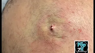 Large inflamed cyst I D medical procedure Large cyst pop Cyst hits the floor Juicy pocket