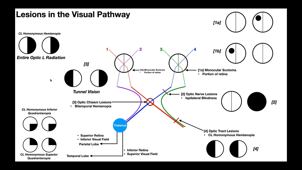 Lesions to the Visual Pathway EXPLAINED