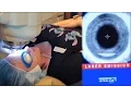 I GOT LASIK DONE LasikPlus for Astigmatism - Does it it