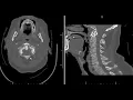 Download Lagu Multi cervical spine trauma