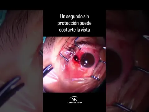 Proteje siempre tu Ojo y EVITA que pase esto ...
