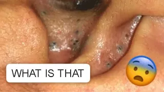 Download UNBELIEVABLE !!! AN EAR FULL OF BLACKHEADS😨... SATISFYING VIDEO #2 #relaxing #blackheads MP3