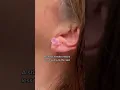 Piercing after earlobe repair 208SkinDoc