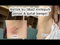 Download Lagu Ketiak Ku Melepuh? Jamur Ketiak ? Ruam Ketiak? Gatel Banget