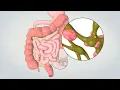 Patient Teaching Left Hemicolectomy Sigmoid Colectomy TVASurg
