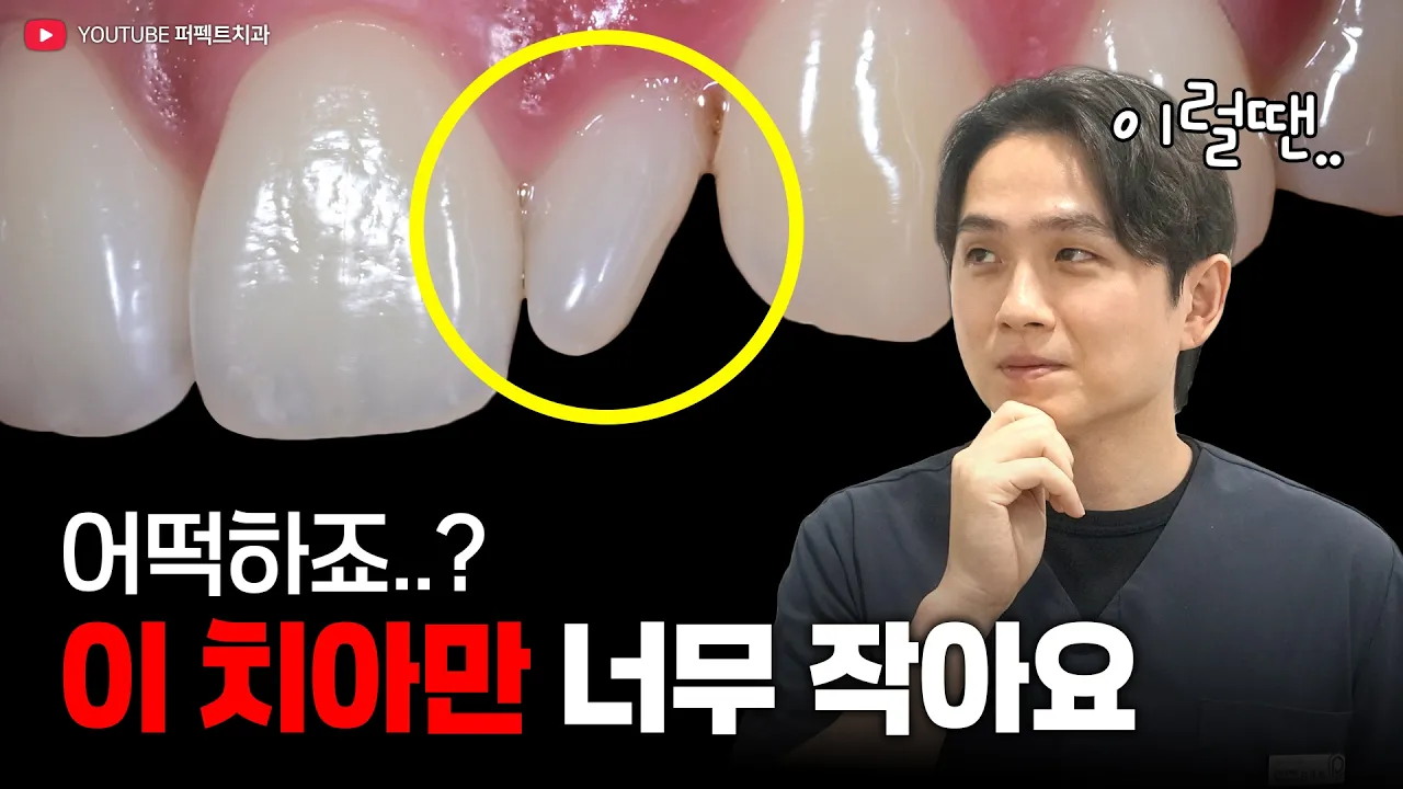 작은치아, 왜소치 어떤 치료가 좋을까? | 라미네이트가 답일까?