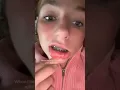 Canker Sores from Braces Do This