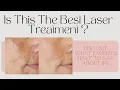 IPL Intense pulsed light Therapy Benefits