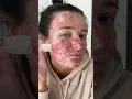 Download Lagu Best Fazit’s Pimple Patch Peels! #acneproneskin #acne #acnepositivity #pimplepopper #pimplepatch