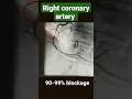 Download Lagu Right coronary artery with 80-90%, 90-99% and 100% blockage ( angiography) #shorts