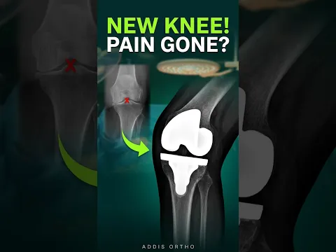 Modern Hip & Knee Replacement Technology Now in Ethiopia | Advanced Joint Replacement Care