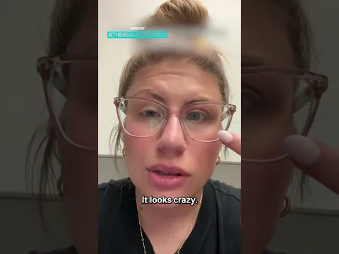 Living with Bell’s Palsy: My Unexpected Journey