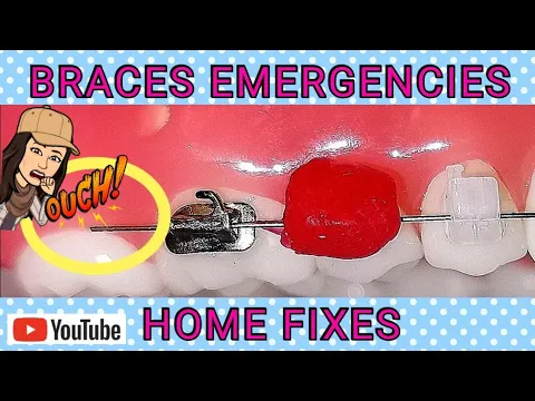 Download MP3 Braces Emergencies! - Fixes! How To Fix Broken Braces at Home if Orthodontist is Closed