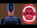 Swollen Uvula Causes And Symptoms