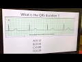 Telemetry Analysis 2 Measuring the Duration of the QRS Complex
