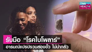 โรคไบโพล่าคืออะไร และมีอาการอย่างไรบ้าง
