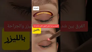 شد الجفن العلوي بالجراحة وبالليزر د محمدأشرف جلديه وليزر 
