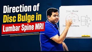 L4-L5-S1 Disc Bulge MRI, Direction of Disc Bulge, Lumbar Canal Stenosis, Lumbar Spine MRI Reading