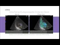 Hitachi Healthcare Vector Flow Mapping VFM YouTube