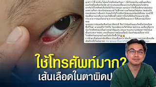  ทำไมการใช้โทรศัพท์มือถือต่อเนื่องเป็นเวลานาน ถึงอาจทำให้ตาเลือดออกได้ 