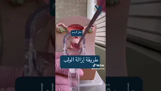 طريقة ازالة اللولب اكسبلور ترندتيكتوك حمل Pregnantwoman تيك توك ترند Fyp 