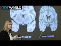Aaron Hernandez and CTE Interview with Susan Candiotti