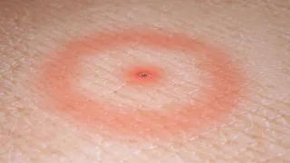 مرض لايم  الأعراض والعلاجات دندنها