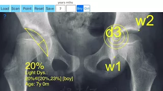 How To Measure Acetabular Depth Ratio ADR With The App AcetabularDepthRatio App 