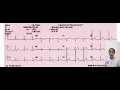 Download Lagu Interprestasi EKG Jantung