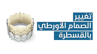        تغيير الصمام الأورطي بالقسطرة  عملية ال  تافي   دندنها