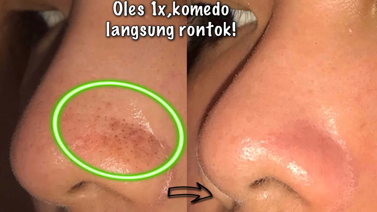 23 CARA MUDAH DAN MUDAH MENGHILANGKAN KOMEDO || MASKER WAJAH, KIAT KECANTIKAN ALAMI