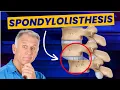 Spondylolisthesis 4 Exercises to Reduce Pain Demo on Real Patient