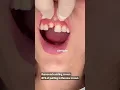 Front tooth crown porcelain crown procedure dental crown Dr Yazdan