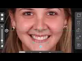 DSD Analisis (Smile Designer Pro software) cosmetic veneers composite porcelain dental lab