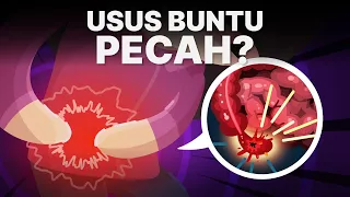 Apa yang Terjadi Jika Usus Buntu Kita Pecah?