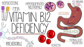 Vitamin B12 Deficiency Explained Clearly