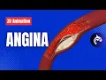 Angina (3D-animatie) - Begrijp pijn op de borst door verminderde bloedstroom naar het hart